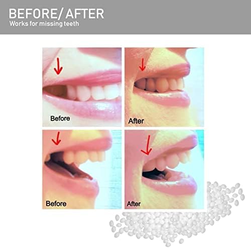 Комплект за ремонт на зъбите F. ZENI, Сет за временна замяна на зъбите, Термосвиваеми мъниста Направи си сам, Formable изкуствени